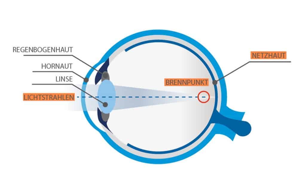 Auge mit Kurzsichtigkeit