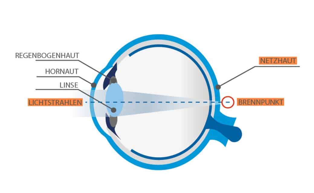 Auge mit Weitsichtigkeit